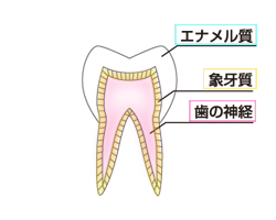 虫歯のメカニズム